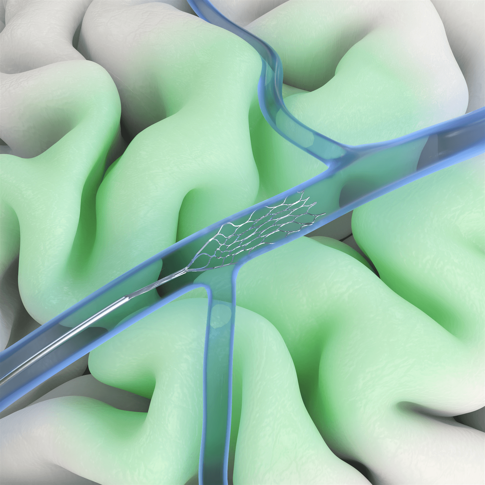 Synchron's Stentrode device is threaded through the jugular vein into the brain.