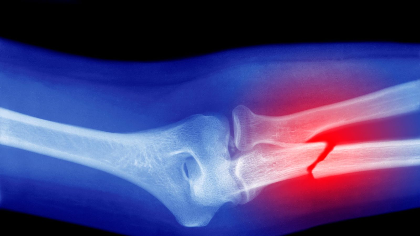 Microplastics Could Be Weakening Your Bones, Research Suggests